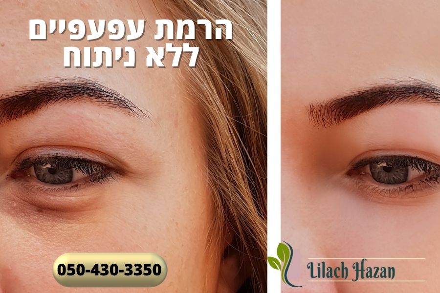 הרמת עפעפיים ללא ניתוח