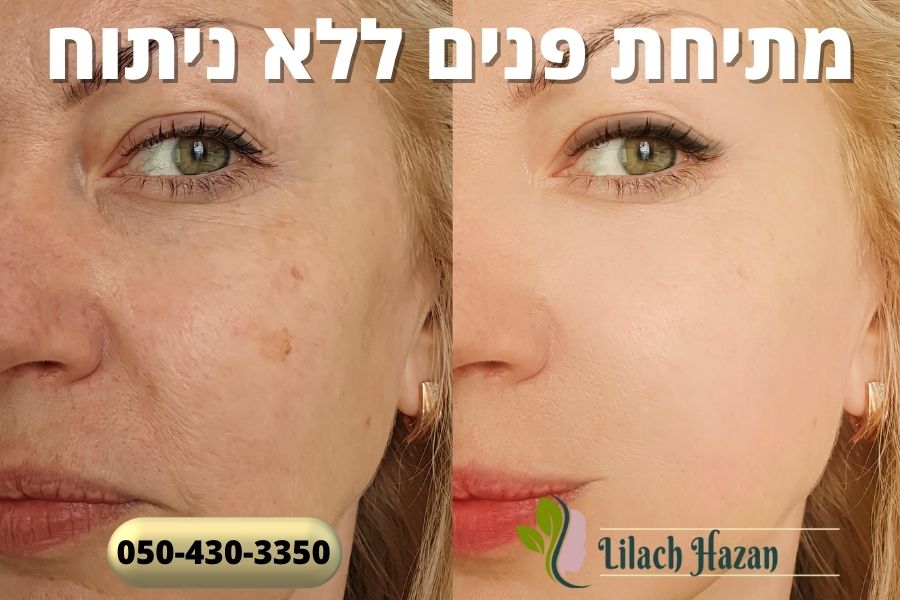 מתיחת פנים ללא ניתוח